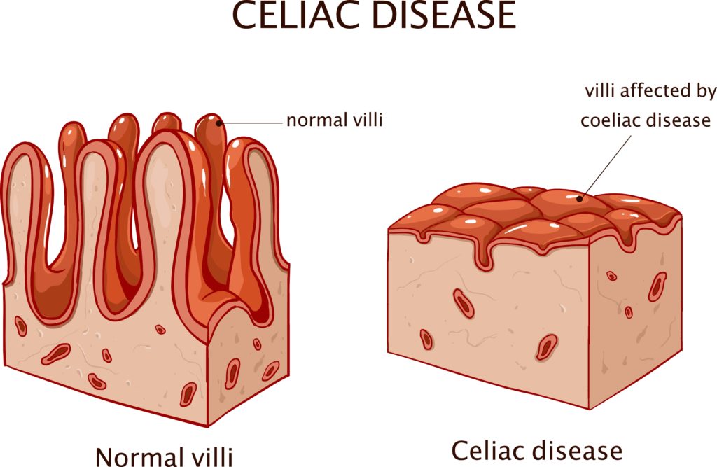 normal villi vs. celiac disease