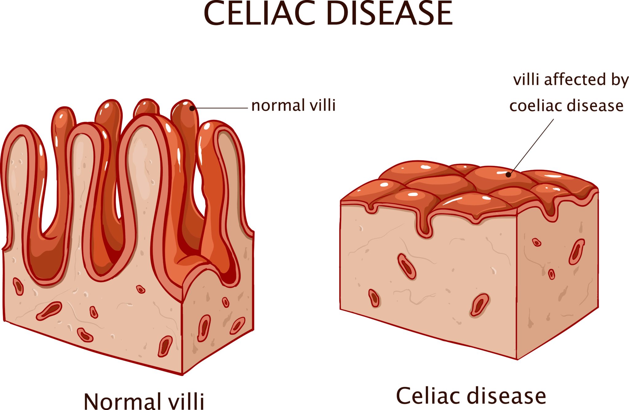 Síntomas celiaquia